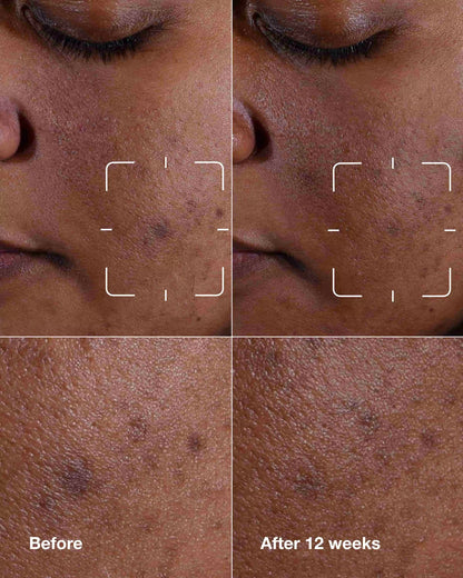 Even Better Clinical™ Dark Spot Clearing Serum - US 7702