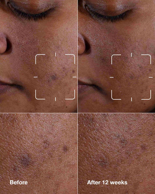 Even Better Clinical™ Dark Spot Clearing Serum - US 7702