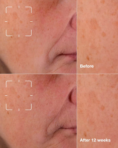 Even Better Clinical™ Dark Spot Clearing Serum - US 7702